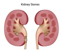 Gout and Kidney Disease